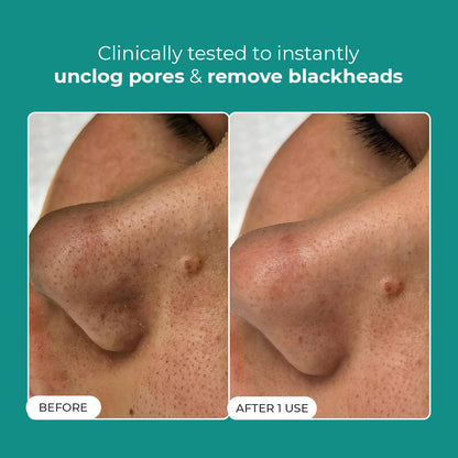 Blackhead Melting Water | 130 ml | Pre-Access