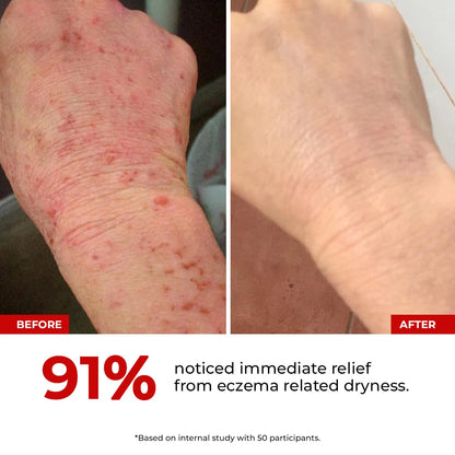 HOCL Skin Relief Spray | Redness Relief Formula | 100 ml