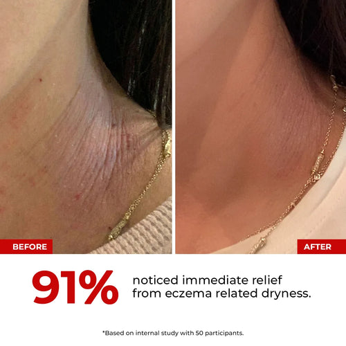 HOCL Daily Spray | Fights Body Odour, Acne & Irritation | Flash Sale