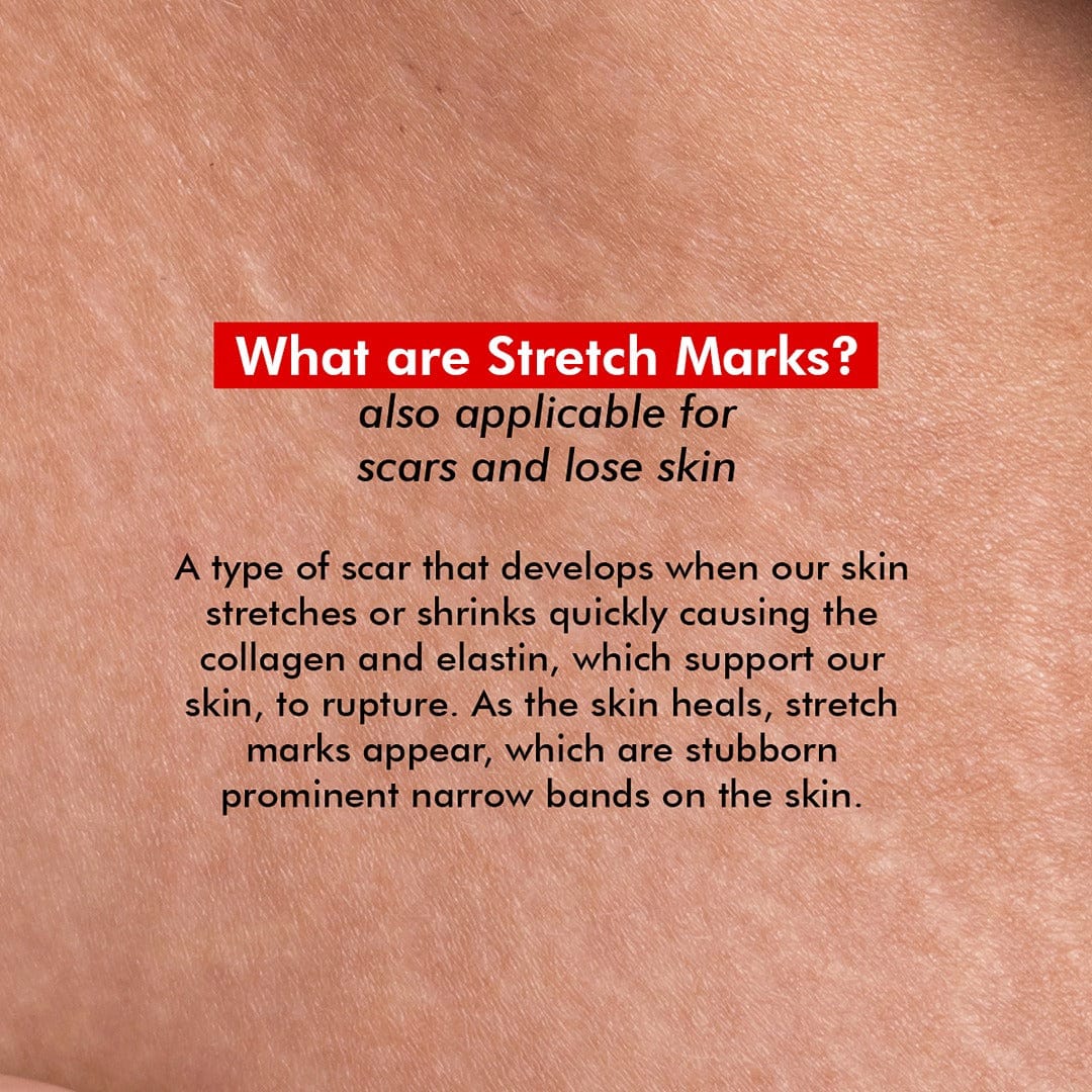 Resurfacing Body Cream | Treats Stretch Marks, Fine Lines & Wrinkles | 100 ml