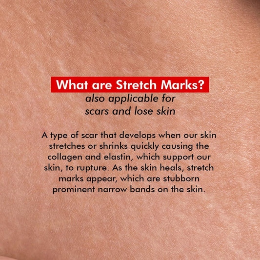 Resurfacing Body Cream for Stretch Marks, Fine Lines & Wrinkles