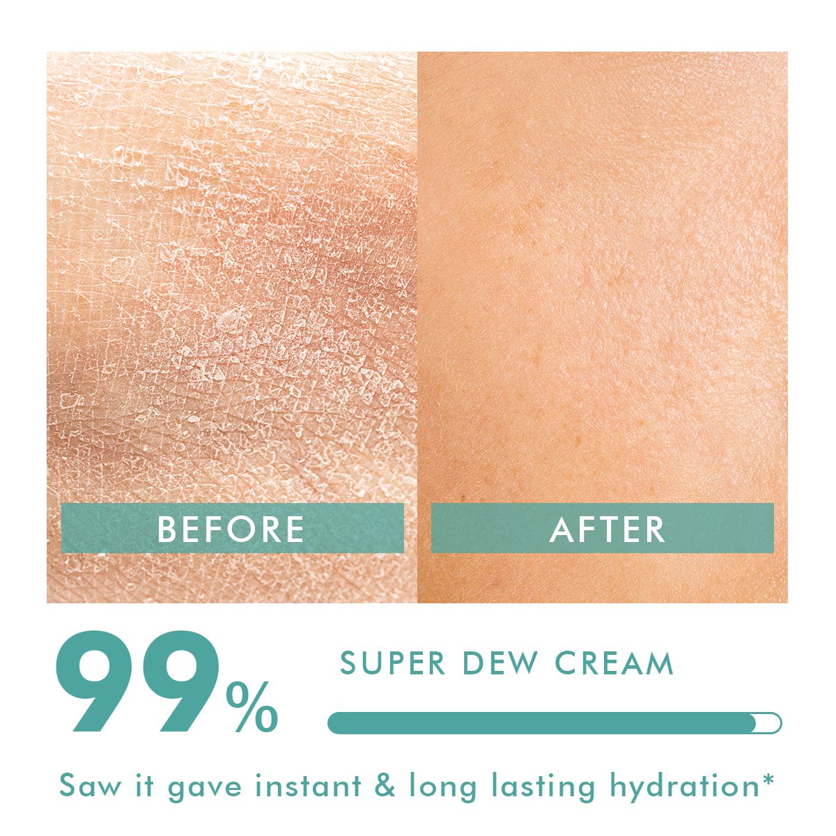 Hydrating Body Cream | Treats Dry & Itchy Skin  | 150 gm