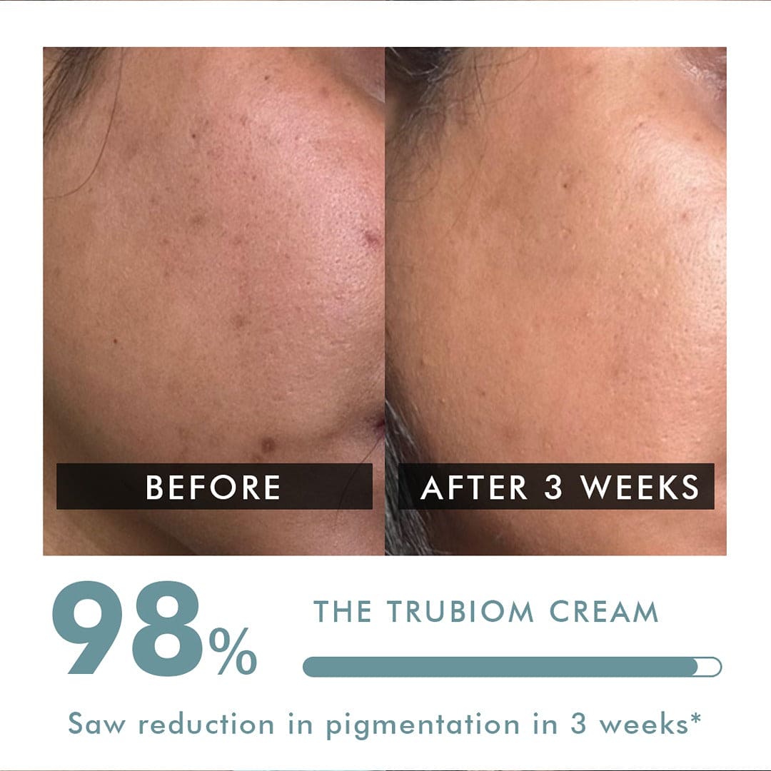 Pigmentation & Dark Spot Corrector Gel Cream | Treats Hyperpigmentation on Face, Elbows, Knees, Neck & Armpits