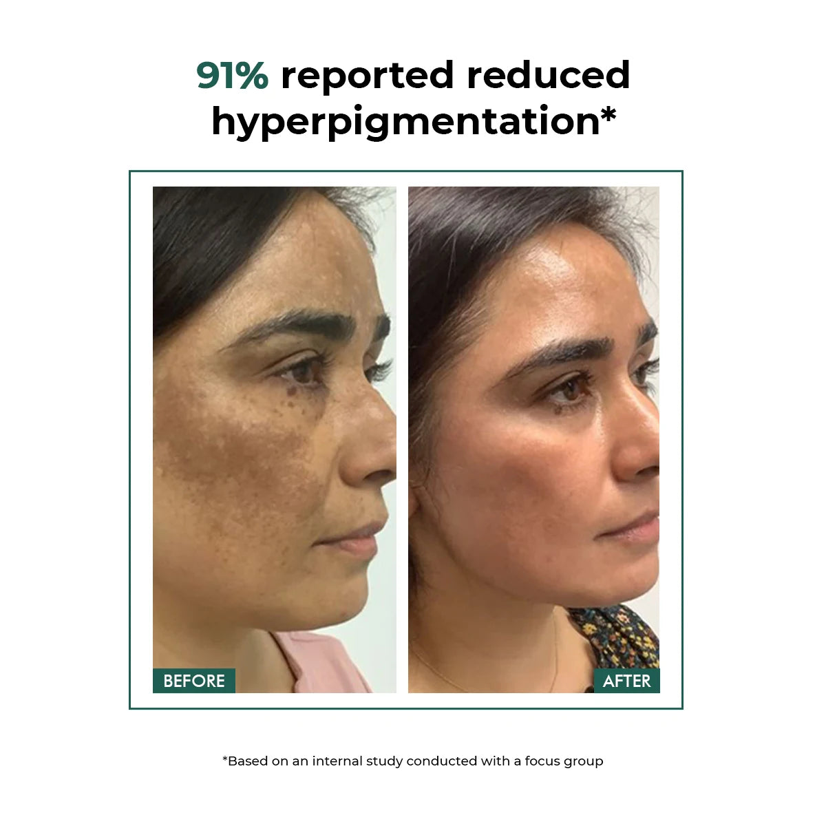 Acne Marks & Pigmentation Control Kit