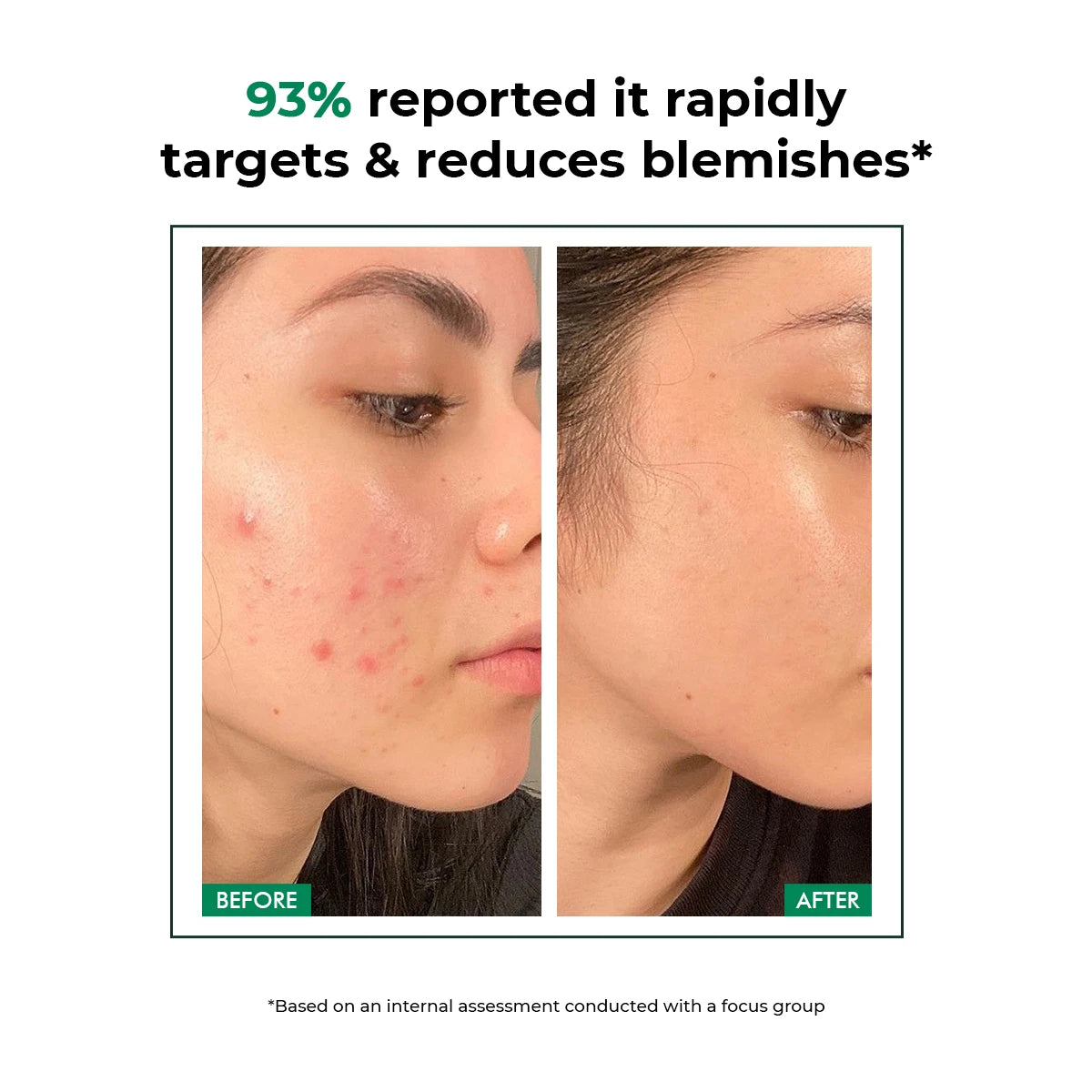 Acne Care Duo | Spot Corrector Gel + Microneedle Patches for Fast Healing & Scar-Free Skin