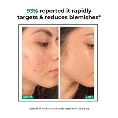 Acne Care Duo | Spot Corrector Gel + Microneedle Patches for Fast Healing & Scar-Free Skin